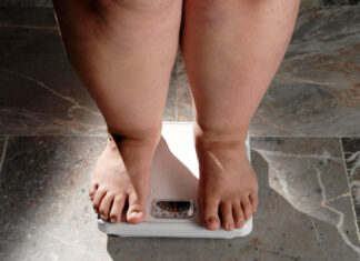 Obesidade: quando ir além do tratamento clínico e considerar a cirurgia? Obesidade