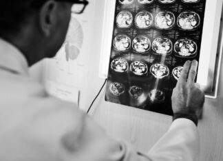 Atendimento rápido pode reduzir lesões em caso de AVC, diz neurocirurgião Acidente Vascular Cerebral (AVC)