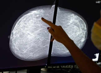 Atividades físicas ajudam na prevenção, tratamento e recuperação de câncer Tomossíntese mamografia câncer de mama