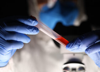 Biópsia líquida traz avanços para pesquisa em câncer de pulmão biópsia líquida