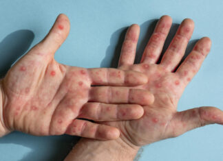 Brasil contabiliza 1.578 casos de mpox (varíola dos macacos) em 2024 mpox