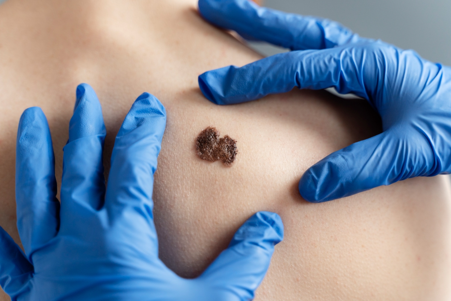 Sociedade Brasileira de Dermatologia intensifica combate ao câncer de pele câmcer de pele - Dezembro Laranja