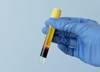 Simples exame de sangue pode ajudar na detecção do câncer de próstata exame de sangue - câncer de próstata