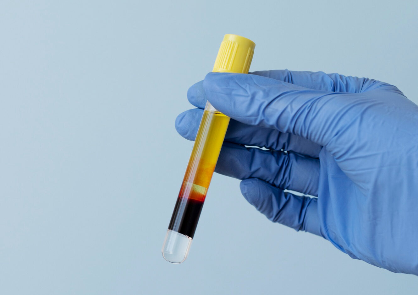 exame de sangue - câncer de próstata