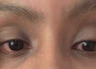 Conjuntivite no DF acende alerta de transmissão