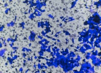 Pesquisa da UnB investiga enzima ligada à metástase do câncer de mama