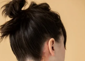 Psoríase afeta 125 milhões no mundo