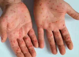 SP confirma 2º caso de mpox agressiva do grupo lp