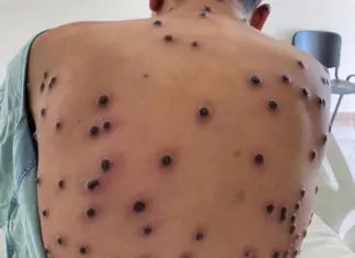 Brasil soma 88 casos de mpox e SP diverge do Ministério Mpox brasil com 88 casos confirmados em 2026 e orientações de prevenção