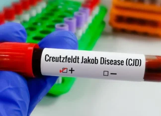 Doença de Creutzfeldt-Jakob e o caso Lito Sousa Doença CJD